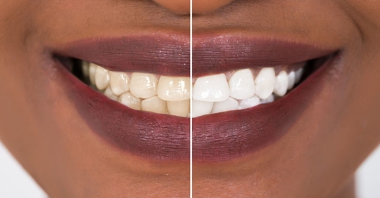 Photo of an African American individual smiling, with a line down the middle. On the left, teeth are yellow-tined, on the right, they are white.