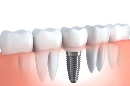 Dental implants graphic