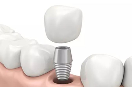 Dental implants graphic