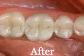 Smile Crown Procedure After