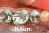 Smile Crown Procedure Before