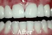 Smile Procedure After