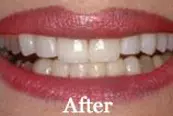 Smile Sperling Veneers After