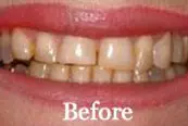 Smile Sperling Veneers Before